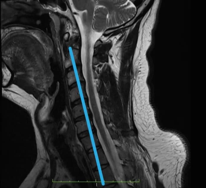 Skręcenie karku: Jak rozpoznać uraz i kiedy na SOR?