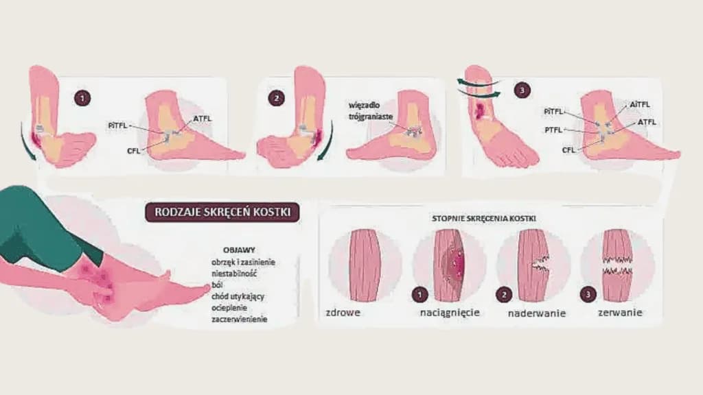 Skręcenie kostki: Co robić? Szybki powrót do formy poradnik.