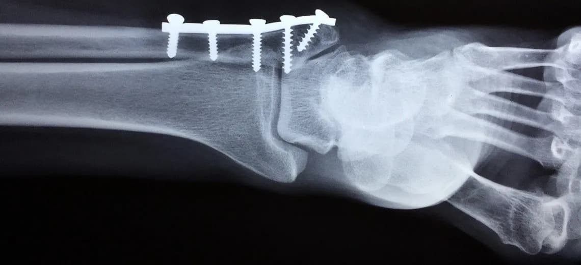 Skręcenie biodra: objawy, leczenie, jak odróżnić od złamania?