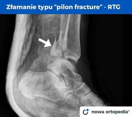 Złamana kostka boczna: Ile trwa leczenie i powrót do sprawności?