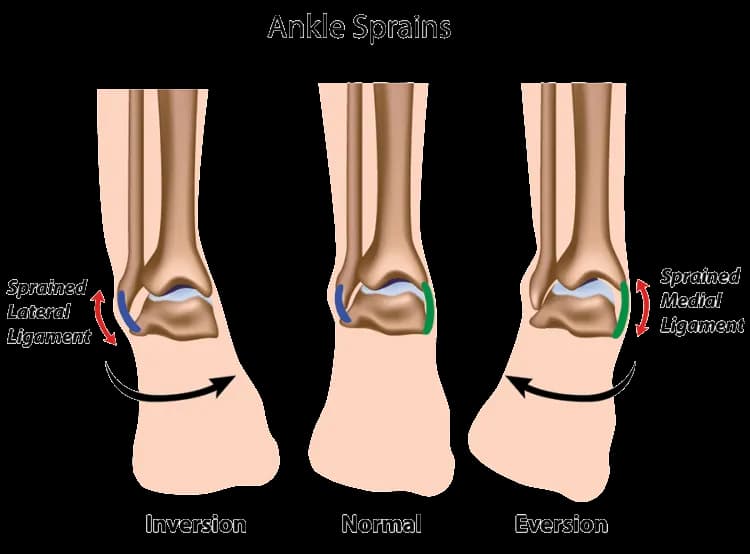 Skręcenie śródstopia: objawy. Jak odróżnić od zwykłej kontuzji?