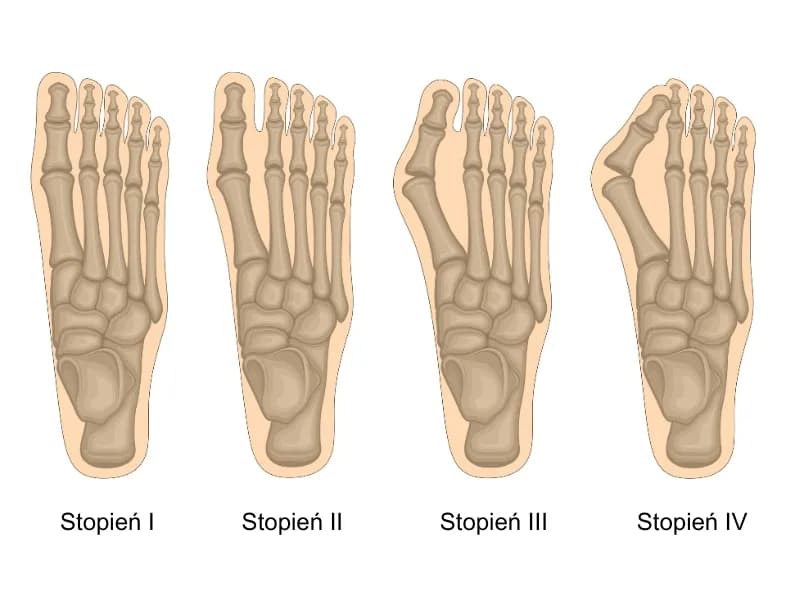 Haluksy: Jak rozpoznać paluch koślawy w domu?
