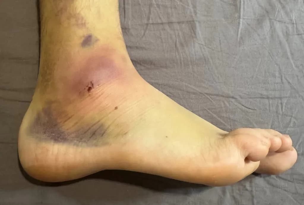 Skręcona kostka: Jak długo trwa? Kalendarz rekonwalescencji