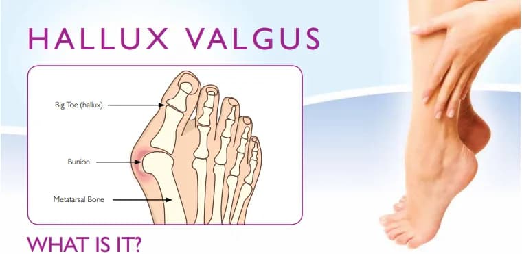 Do jakiego lekarza z haluksami? Ortopeda, podolog, fizjoterapeuta