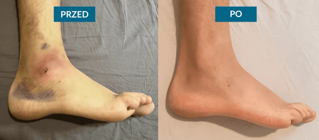 Jak szybko wyleczyć skręconą kostkę? Plan działania i rehabilitacja