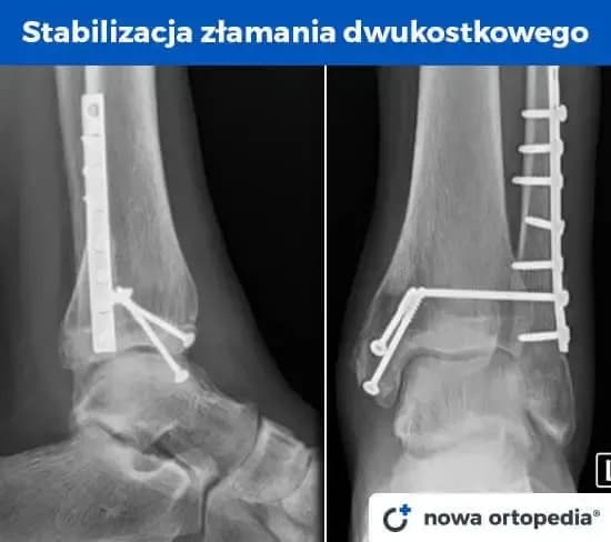 Złamana kość? Ile trwa rehabilitacja i jak wrócić do formy?