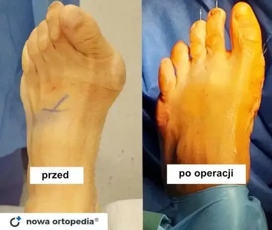Ortopeda od haluksów: Kto leczy? Jak wygląda leczenie?