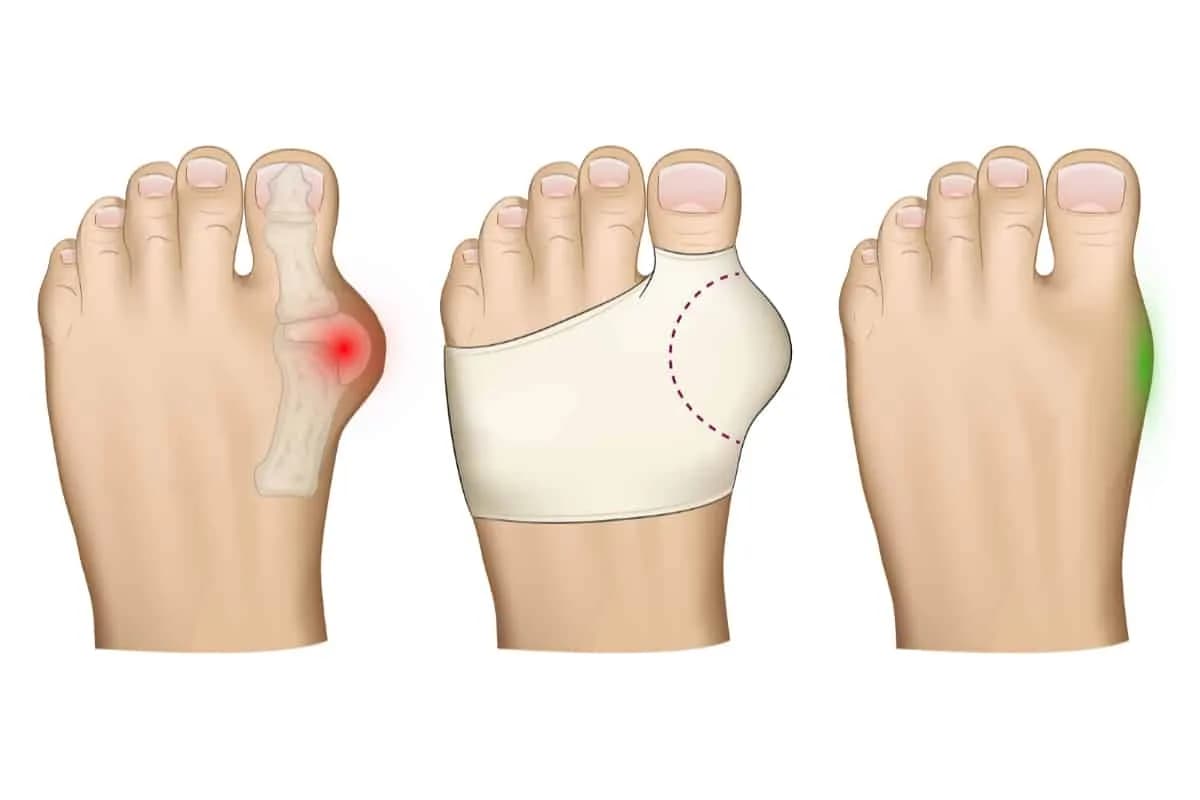 Haluksy: Czym są, jak je rozpoznać i leczyć?