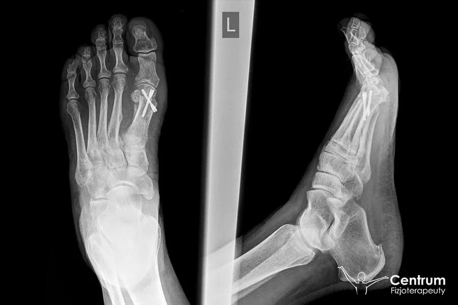 Haluksy: ile trwa operacja i powrót do pełnej sprawności?