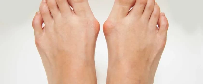 Haluksy: przyczyny, objawy i skuteczne leczenie - poznaj wszystko