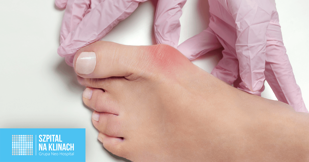 Haluksy: Skuteczne metody leczenia, ćwiczenia i profilaktyka